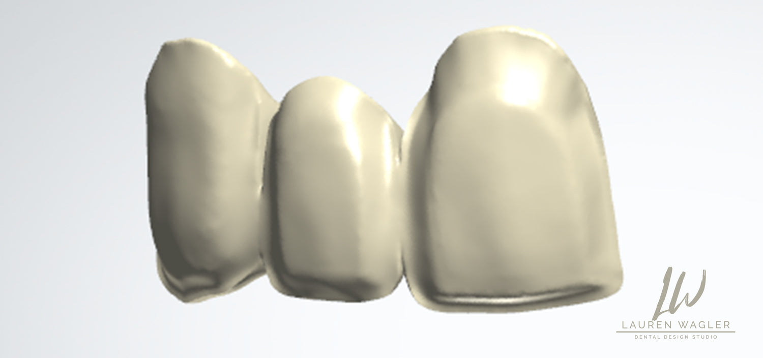Layered Mono Zirconia Digital Design