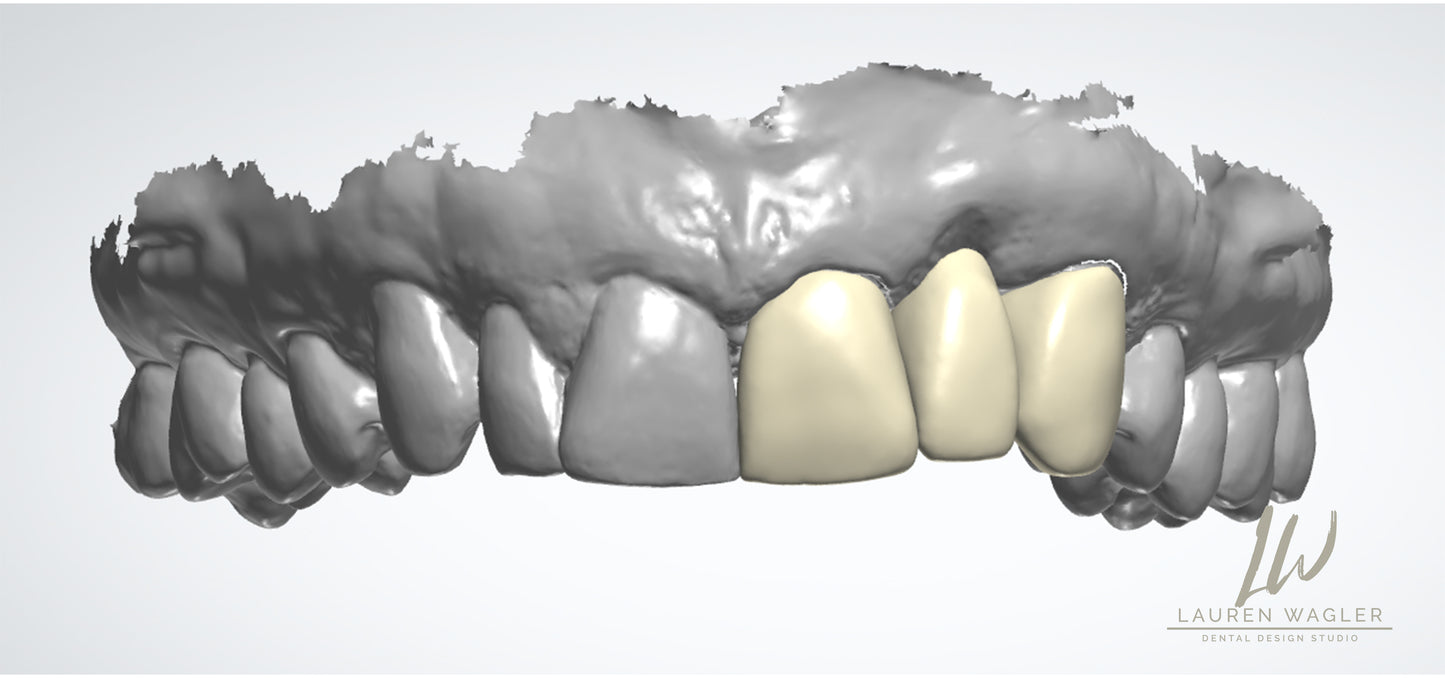 Full Contour Mono Zirconia Digital Design