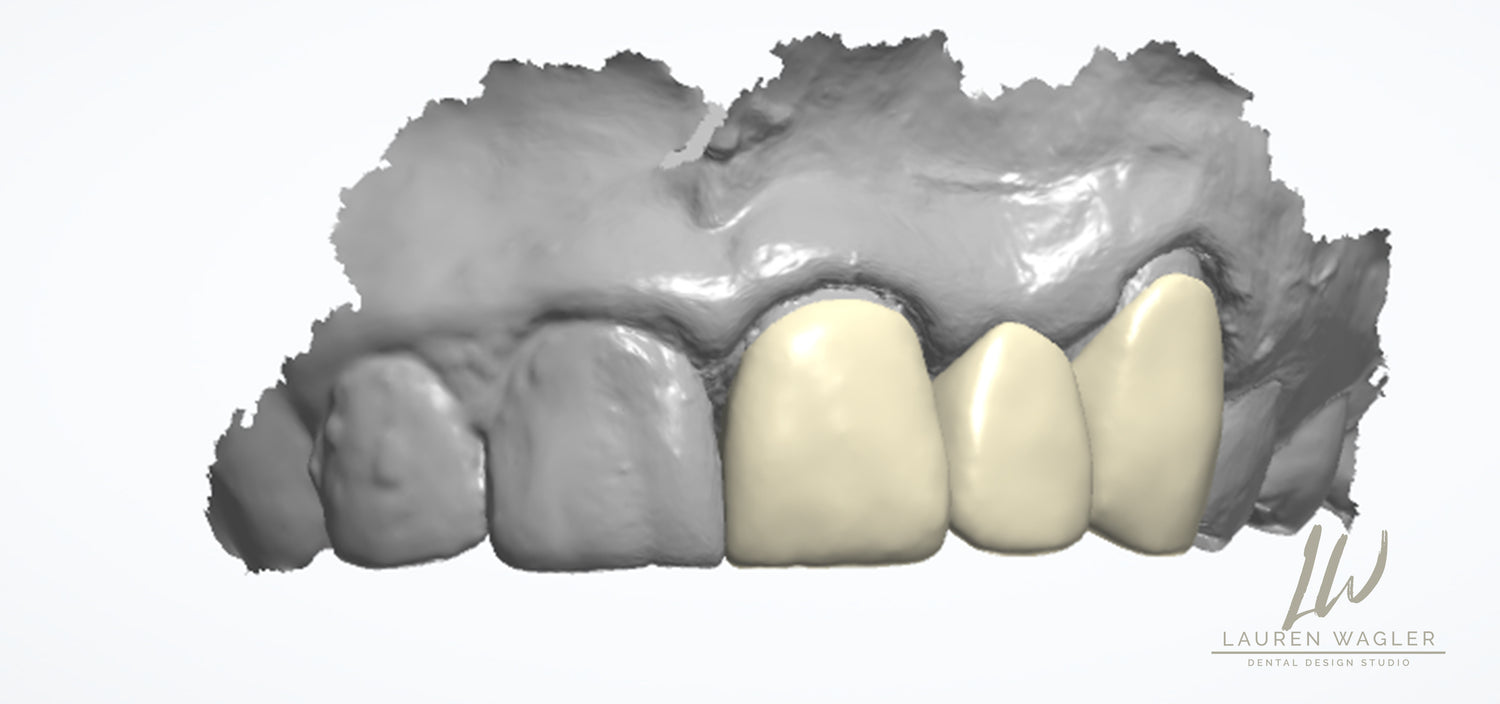 Full Contour Multi-Layer Digital Design