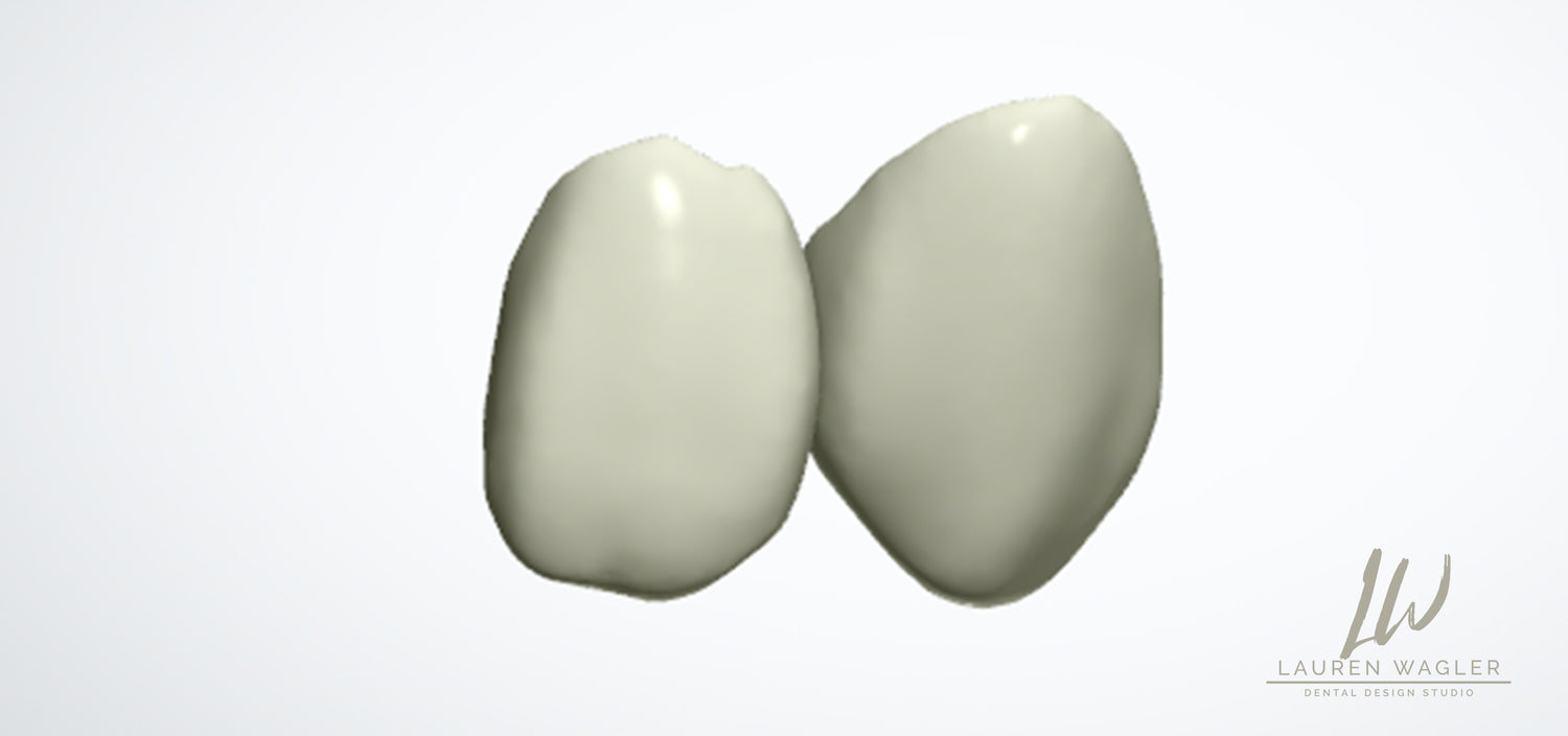Full Contour Emax Digital Design